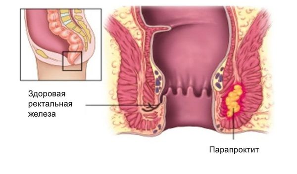 Парапроктит