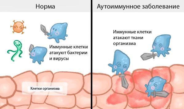 Происхождение аутоиммунных заболеваний