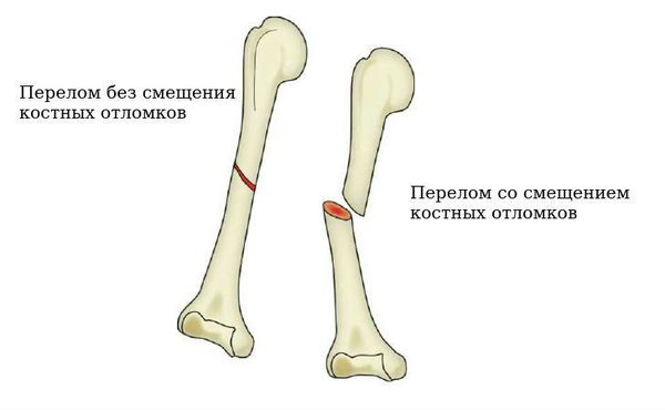 Перелом без смещения и со смещением