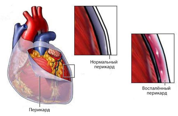 Перикардит