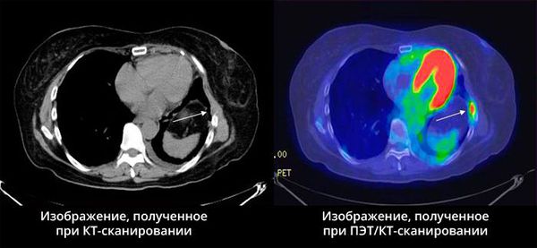 ПЭТ-сканирование