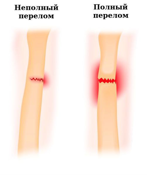 Полный и неполный перелом