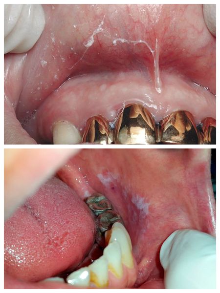 Поражение слизистой полости рта при гальванозе
