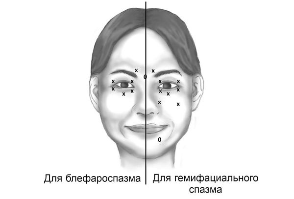 Схема инъекций ботулотоксина