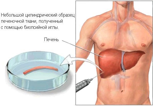 Пункционная биопсия печени