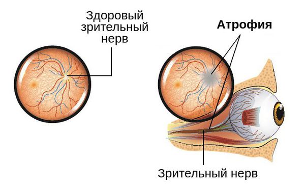 Разрушение зрительного нерва