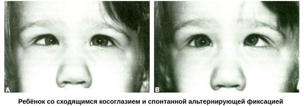 Ребенок со сходящимся косоглазием и альтернирующей фиксацией