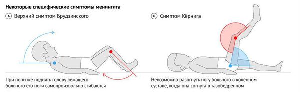 Симптомы Кернига и Брудзинского