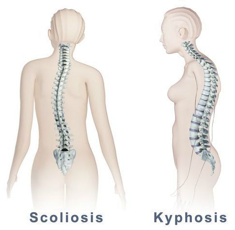 Сколиоз при вертеброгенной торакалгии