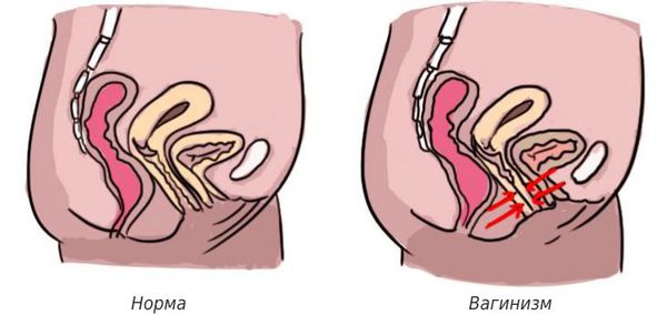 Вагинизм: что это, причины, симптомы, лечение