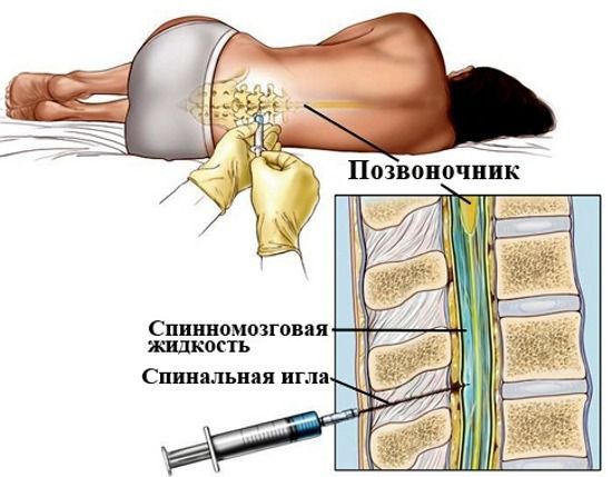 Вирусный менингит - Вирусный менингит - Справочник MSD Профессиональная версия