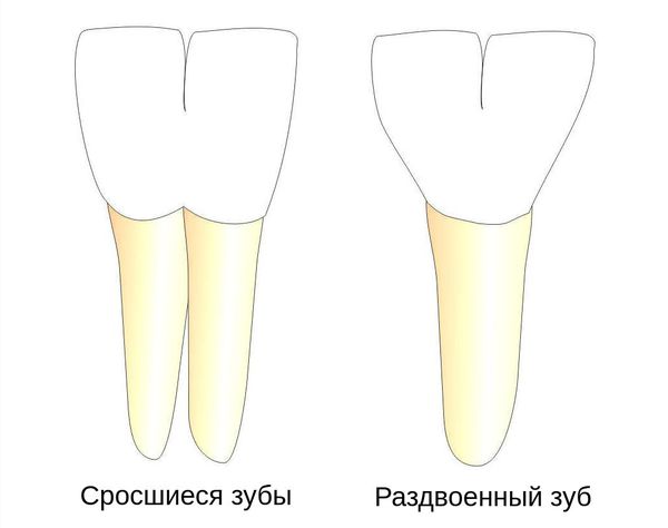 Срастившиеся и расщепленные зубы