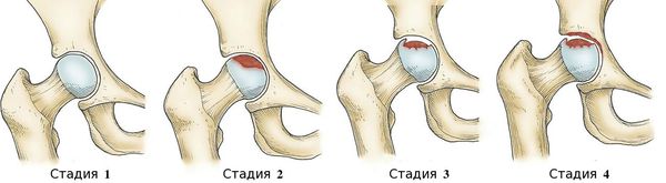 Стадии некроза головки бедренной кости