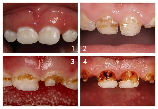 Стадии бутылочного кариеса