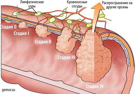 Стадии рака