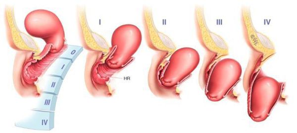 Этапы выпадения влагалища