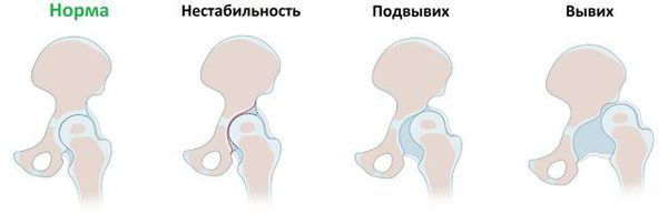 Степени прогрессирования вывиха тазобедренного сустава