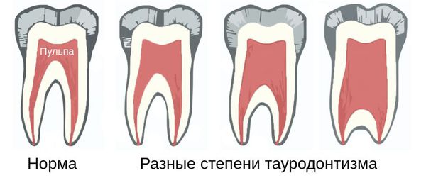 Степени тауродонтизма