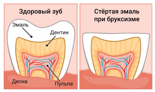 Стёртая эмаль при бруксизме