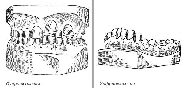 Супраокклюзия и инфраокклюзия