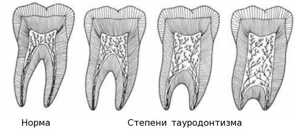 Тауродонтизм