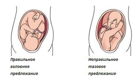 Тазовое предлежание плода