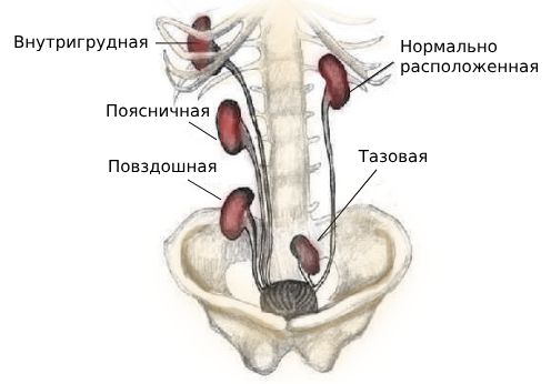 Типы дистопии по локализации