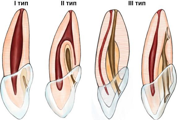 Типы инвагинации зуба