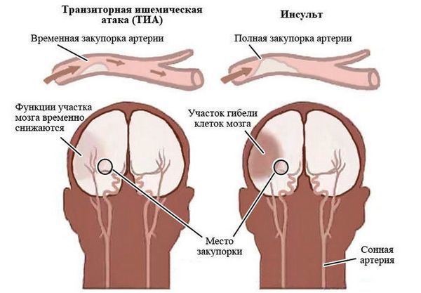 Транзиторная ишемическая атака и ишемический инсульт