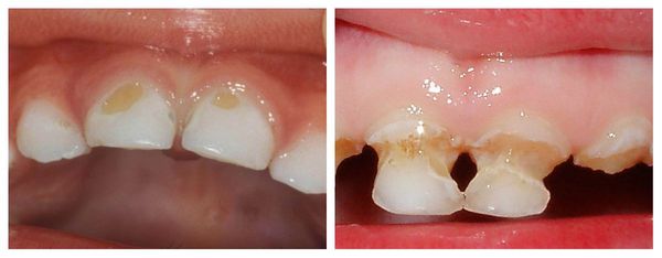Варианты распространения бутылочного кариеса 