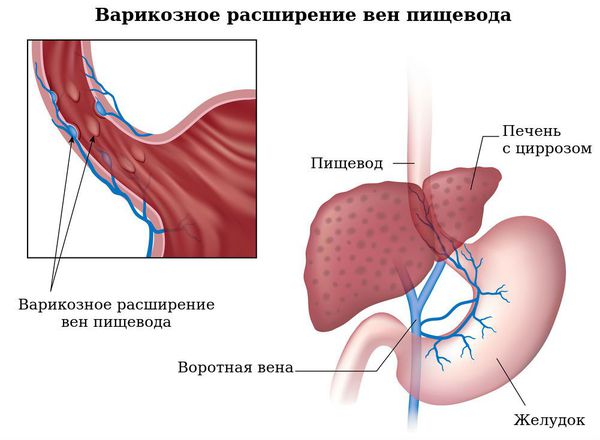 Варикозное расширение вен пищевода