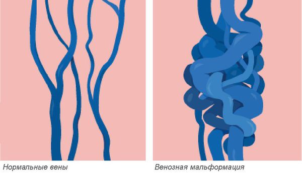 Венозная мальформация: причины, симптомы и лечение