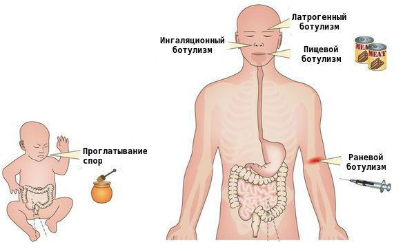 Виды ботулизма