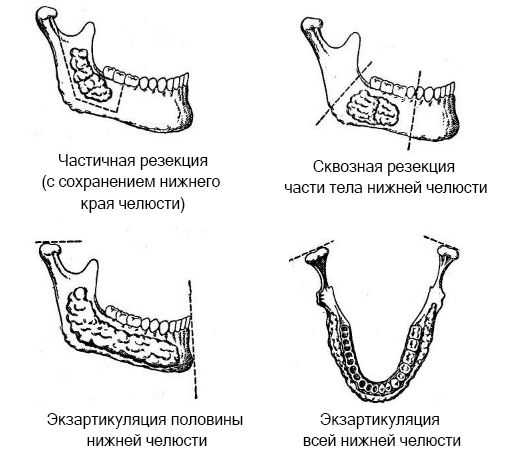 Виды операций при амелобластоме