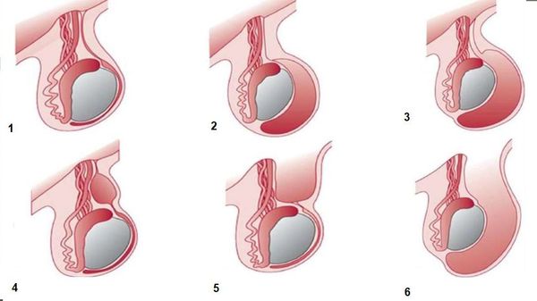 виды водянки оболочек яичка