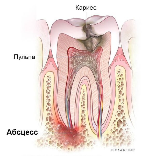 Абсцесс зуба: причины, симптомы и лечение