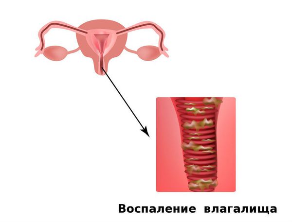 Вульвовагинит: причины, симптомы и лечение