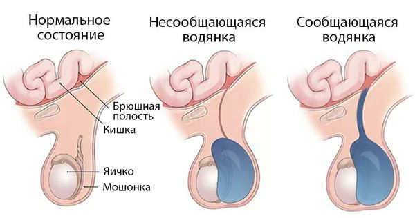 Врожденное гидроцеле