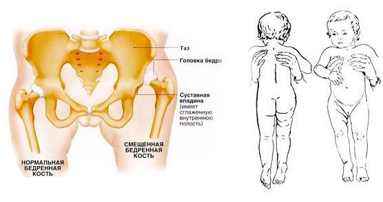 Дисплазия тазобедренного сустава и врождённый вывих бедра: причины, симптомы и лечение