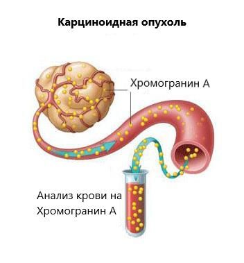 Выделение гормонально-активных веществ карциноидной опухолью