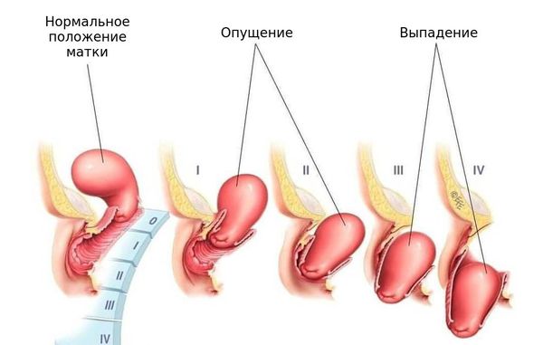 Выпадение матки: причины, симптомы и лечение