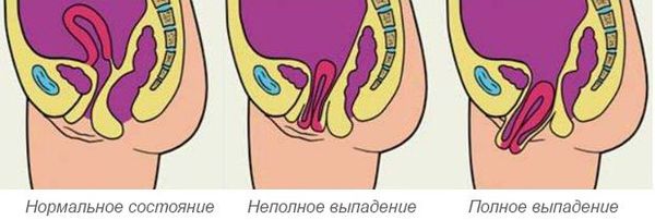 Выпадение влагалища: причины, симптомы и лечение