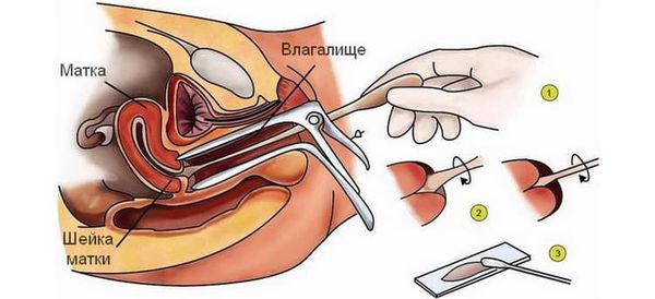 Забор отделяемого цервикального канала