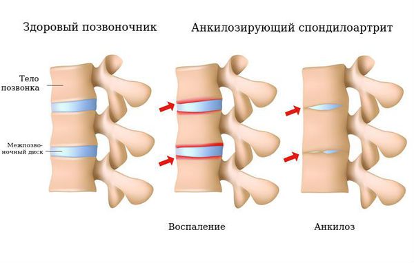 Здоровый позвоночник и анкилозирующий спондилоартрит