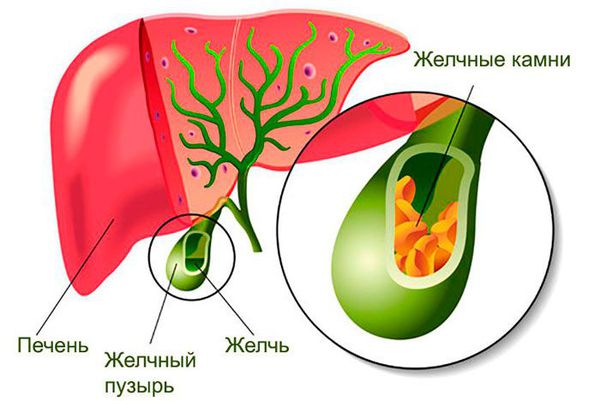 Желчнокаменная болезнь