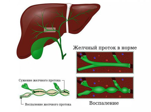 Билиарный цирроз печени: причины, симптомы и лечение