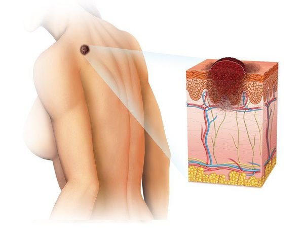 Что такое меланома кожи: причины, диагностика и лечение